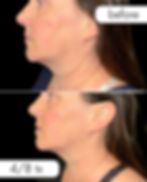 skin tightening nanaimo