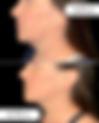 The "Non-Surgical Facelift" of Nanaimo: Everything You Need to Know About Forma RF Skin Tightening