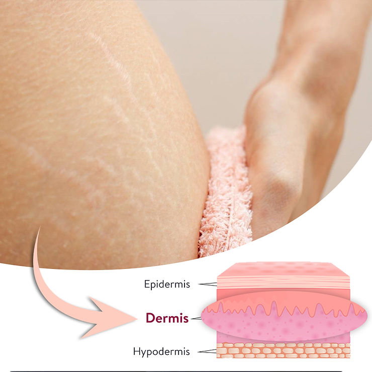 Stretchmarks, antistretchmarks, antistretch mark cream, inostretch