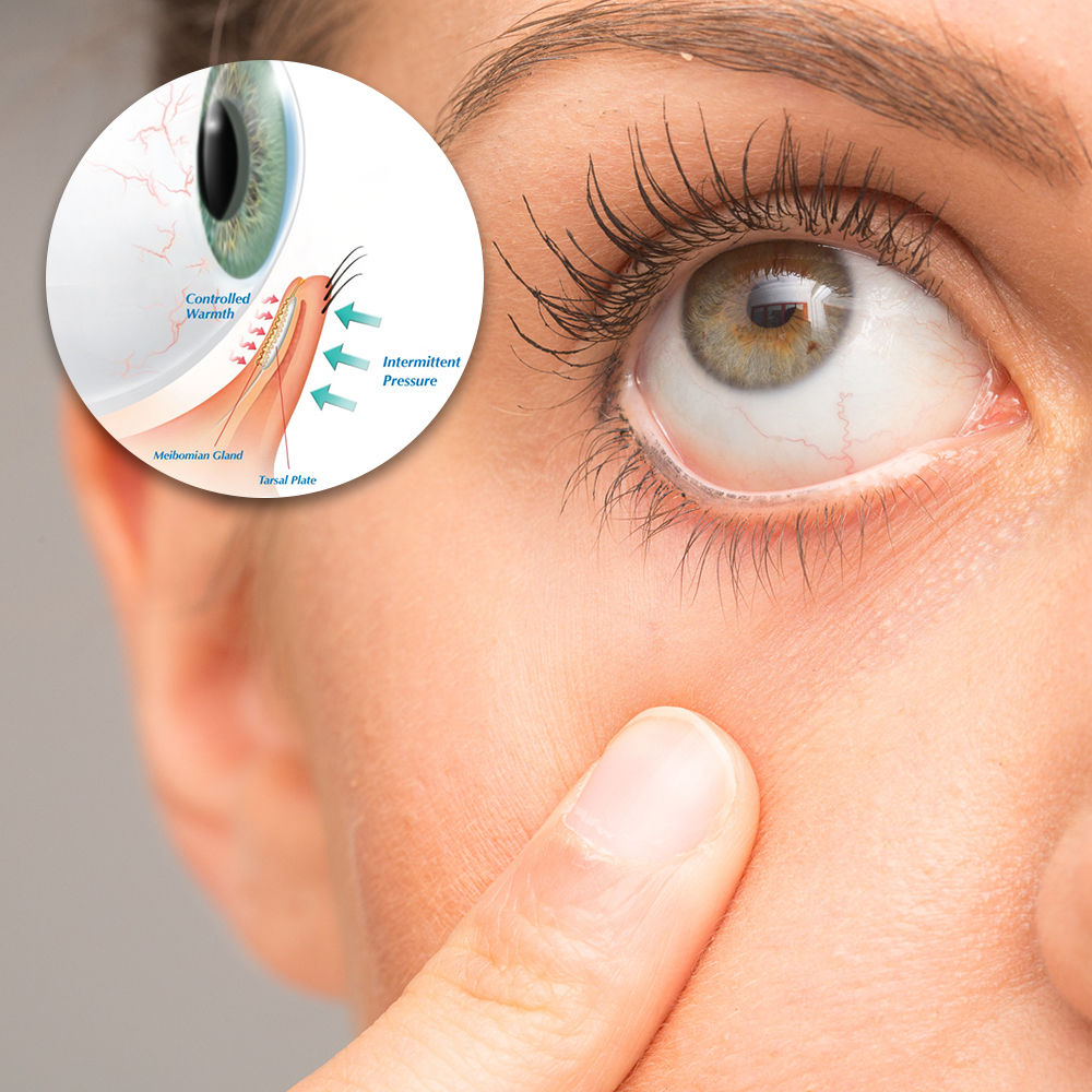 Tear Evaporation of the Eyes Symptoms, Threats and Treatment Lifezen
