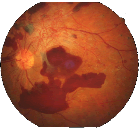 Retinopatia diabetica