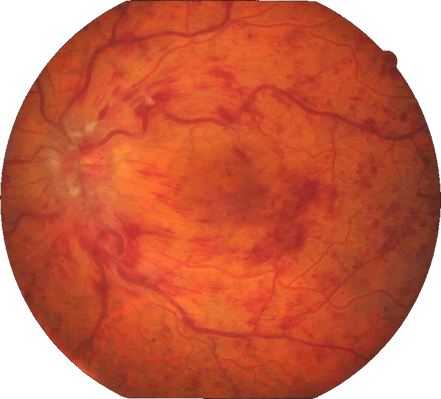 Oclusão venosa edema macular