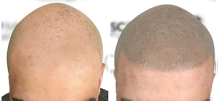 Micropigmentación Capilar scalpmx