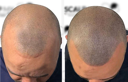 Micropigmentación Capilar ScalpMX