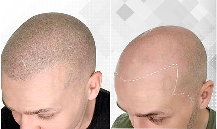 Micropigmentación Capilar ScalpMX