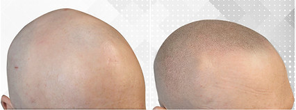 Micropigmentación Capilar ScalpMX