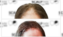 Micropigmentación Capilar ScalpMX Mujeres