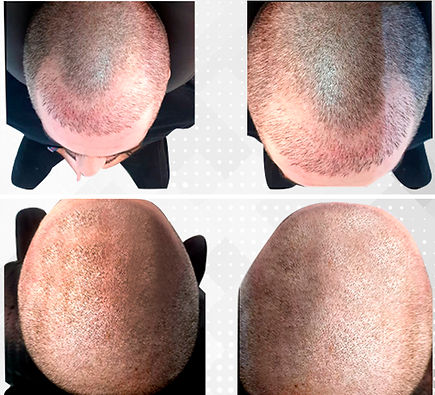 ScalpMX Micropigmentación Capilar