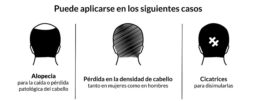 Micropigmentación Capilar México