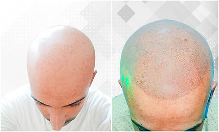 Micropigmentación Capilar ScalpMX Look Rapado