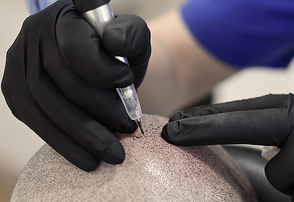 Tricopigmentación Capilar, Microblading