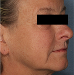 Vorher/ Nachher Bilder Laser-Skin-Resurfacing / Hautverjünung durch Laser Dr. Seker Aschaffenburg