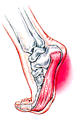 Plantar fasciitis