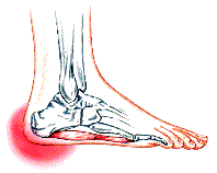 Heel Pain