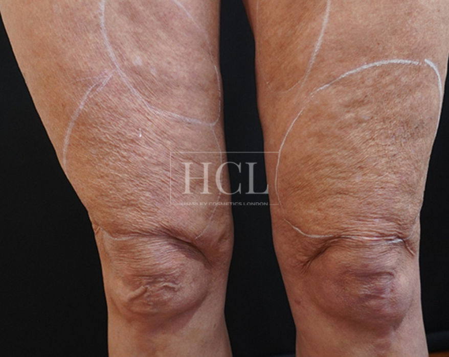 Morpheus8 treatment Harley Cosmetics London & Brentwood