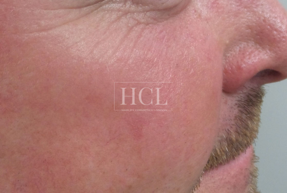 Lumecca Treatment Harley Cosmetics London & Brentwood