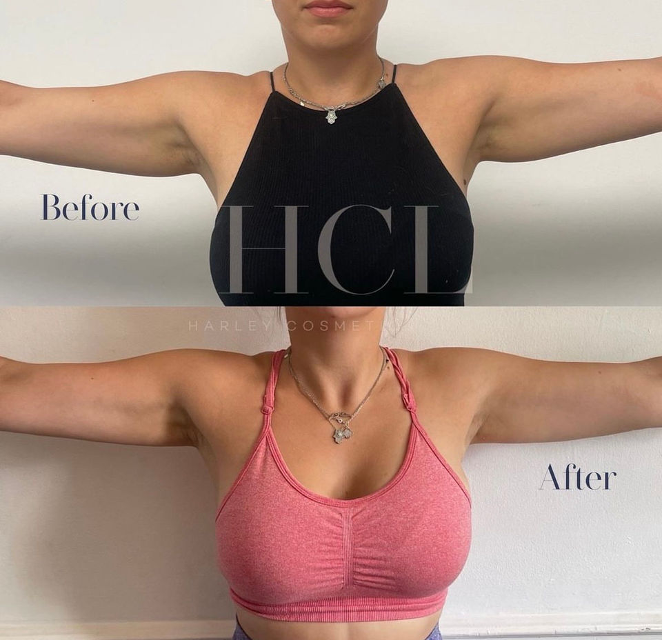 FAT DISSOLVING INJECTIONS Harley Cosmetics London & Brentwood