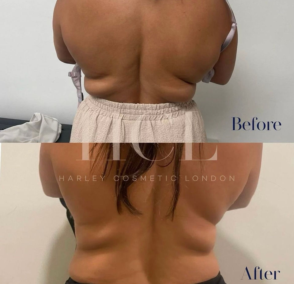 FAT DISSOLVING INJECTIONS Harley Cosmetics London & Brentwood