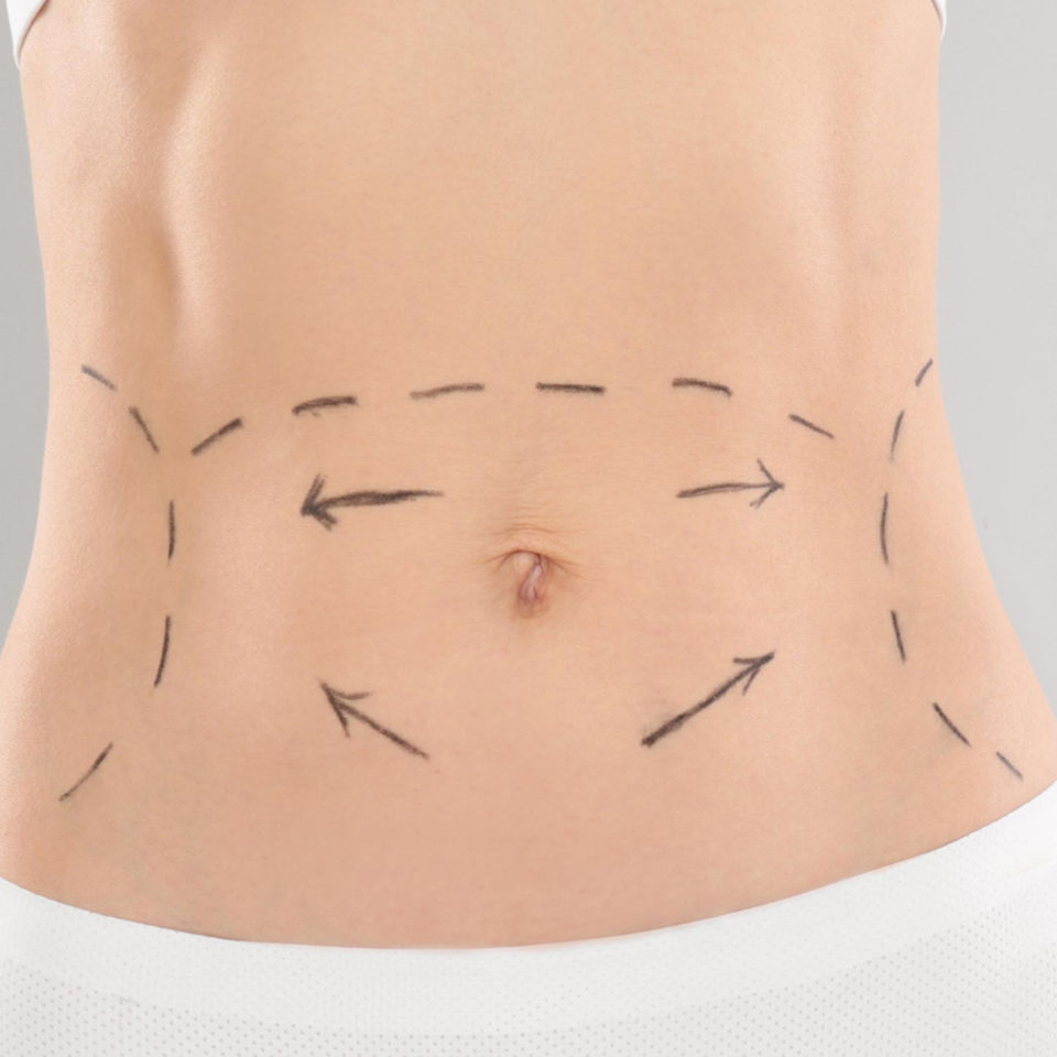 Abdominal Plasty Harley Cosmetics London