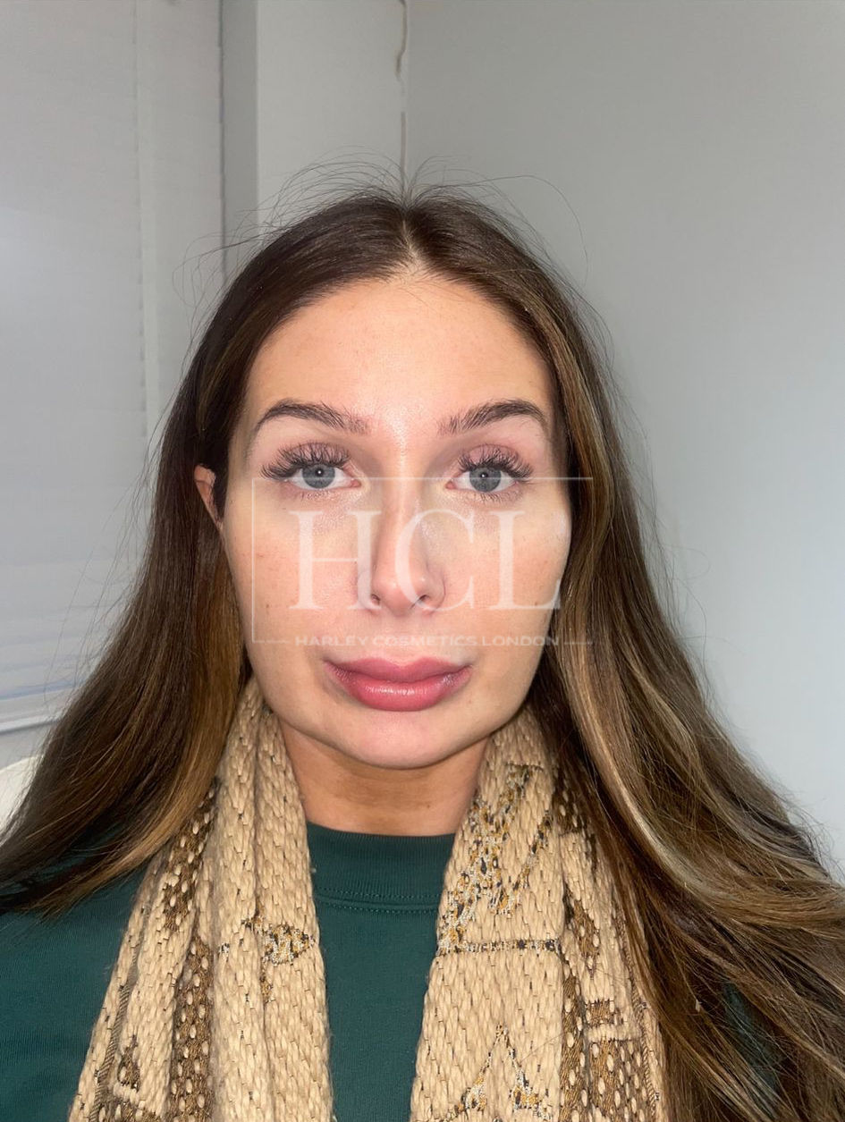 Dermal Fillers treatment Harley Cosmetics London & Brentwood