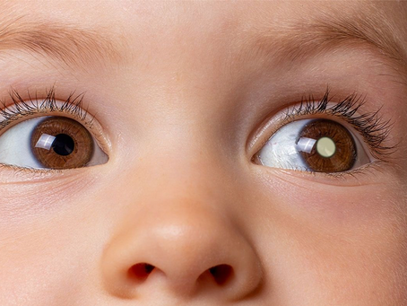 Retinoblastoma: fique atento aos sinais!