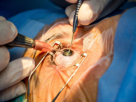 Faça a cirurgia de catarata antes que seus sintomas piorem!