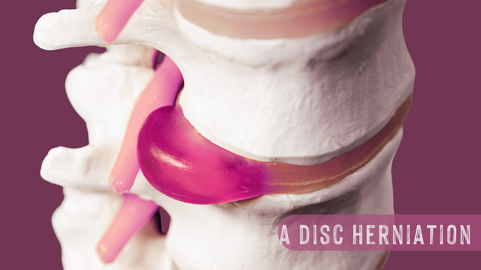a disc herniation