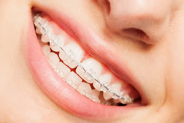 ceramic braces.webp