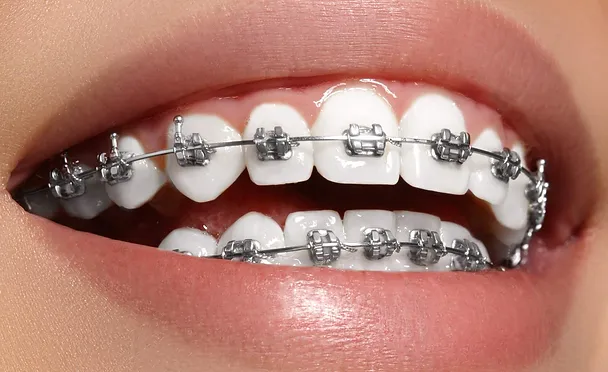 Metal-Braces-img.webp