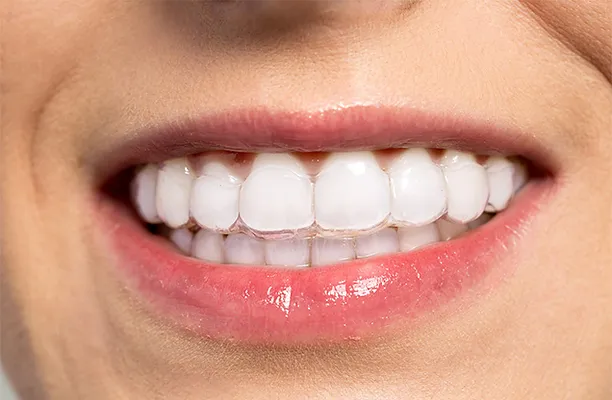 invisalign.webp