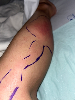 Strep cellulitis spreading up the leg from the bottom of the calf. The doctors trace the rash outline with blue marker so the border can be seen on the leg