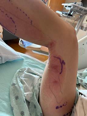Strep Cellulitis looks worse as it continues to spread up the leg and expand the blue marker border. it's a blotchy red rash that makes hard lumps under the skin