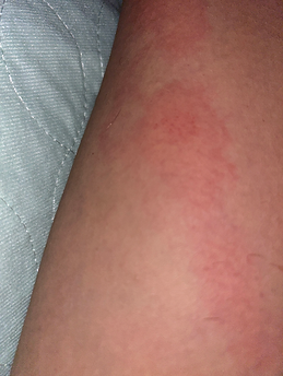 Strep Cellulitis moces toward the lymph nodes so the body can clear the infection