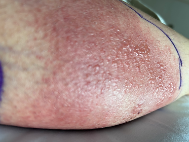 Strep cellulitis starts to bubble and puss as the rash starts to heal. The rash starts to shrink within the blue marker border