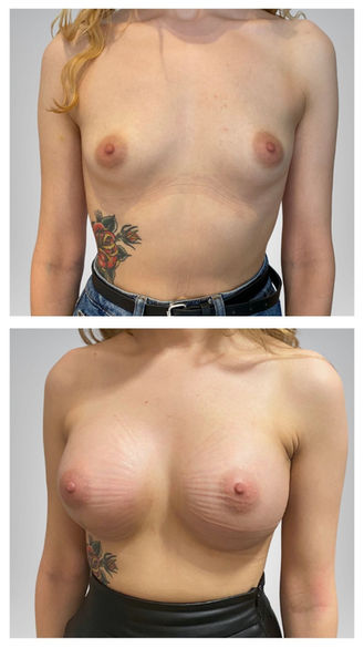 powiększanie piersi, implanty, kobieta, chirurgia plastyczna, plastyk Przybylski, Poznań, Solumed