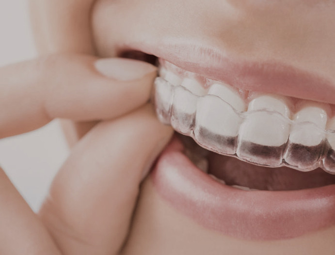 smile-with-invisalign_edited.jpg