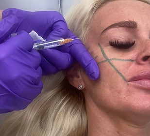 FACE FILLER.jpg