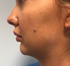 JAW LINE BEFORE.jpeg