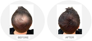 Capillus Japan | 低出力レーザー+近赤外線レーザーによる育毛・薄毛ケア Capillus Japan | 低出力レーザー+近赤外線レーザーによる育毛・薄毛ケア