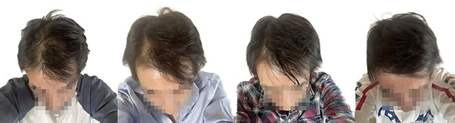 Capillus Spectrum 50代男性 回復例 1年