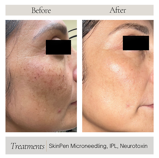 Neutral Before and After Instagram Post.png