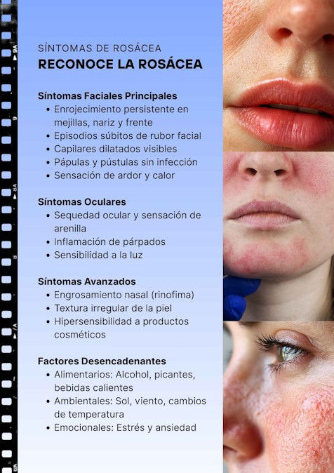Sintomas Reconoce la rosacea