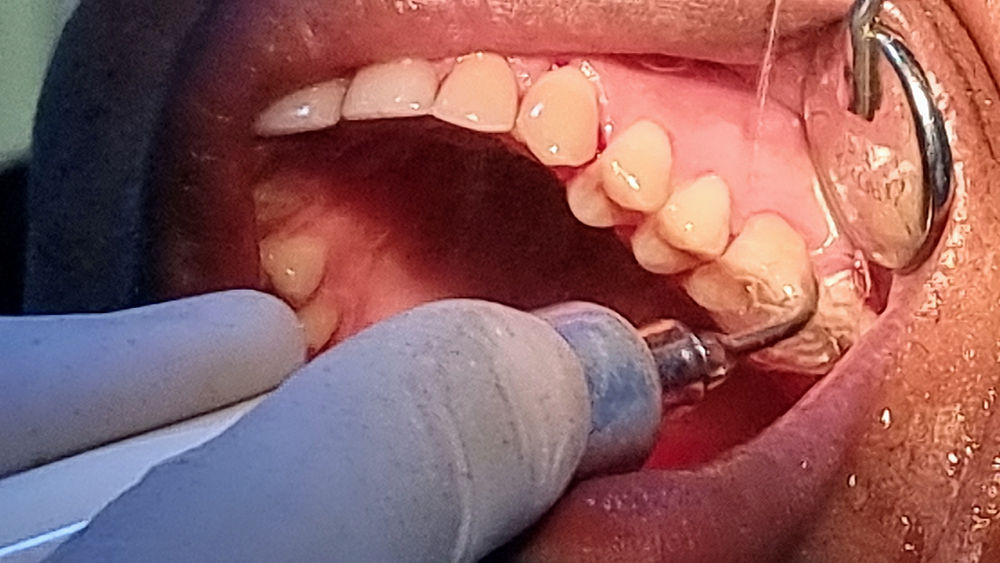 Scaling and Polishing