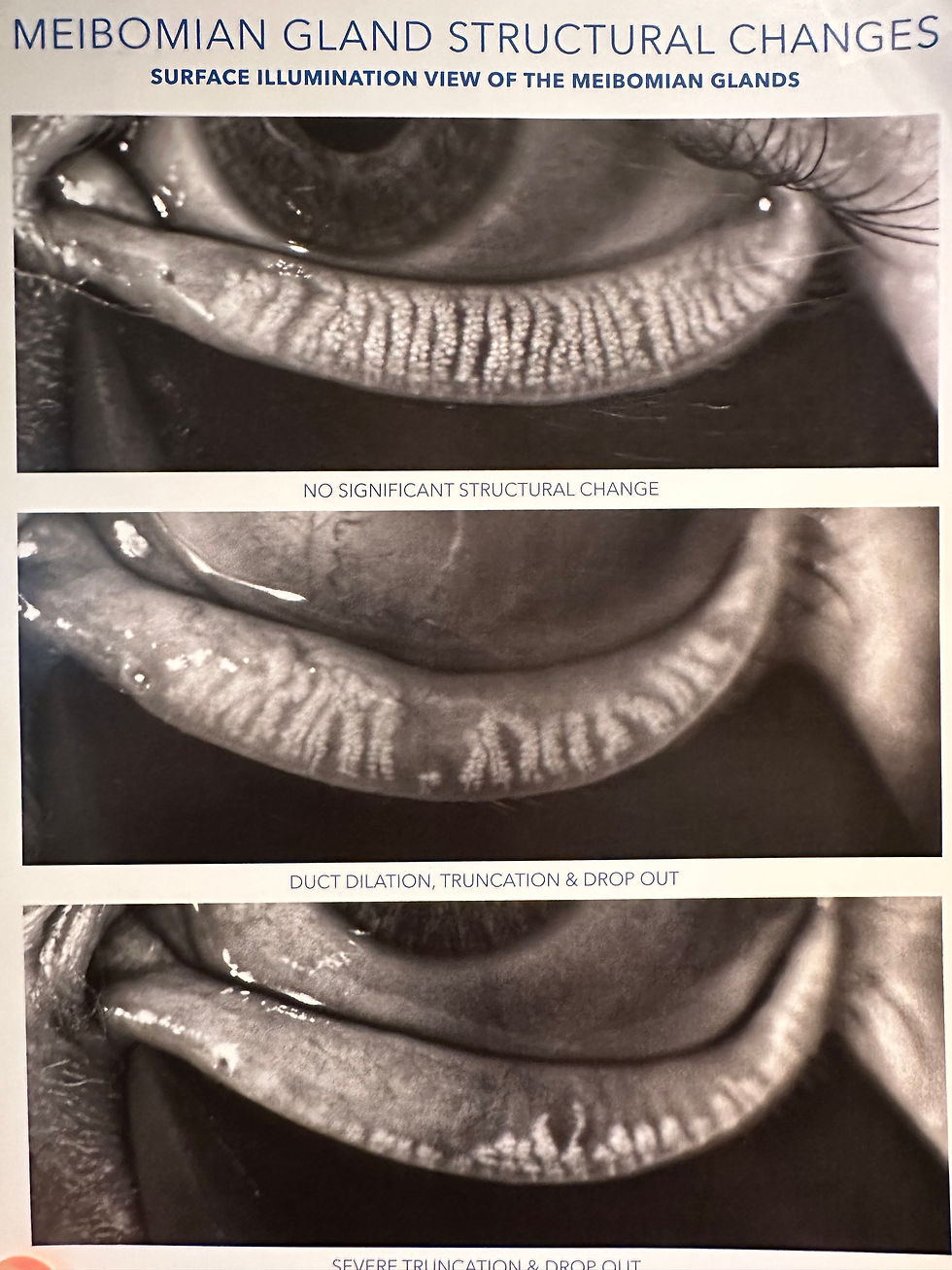 Meibomian Glands