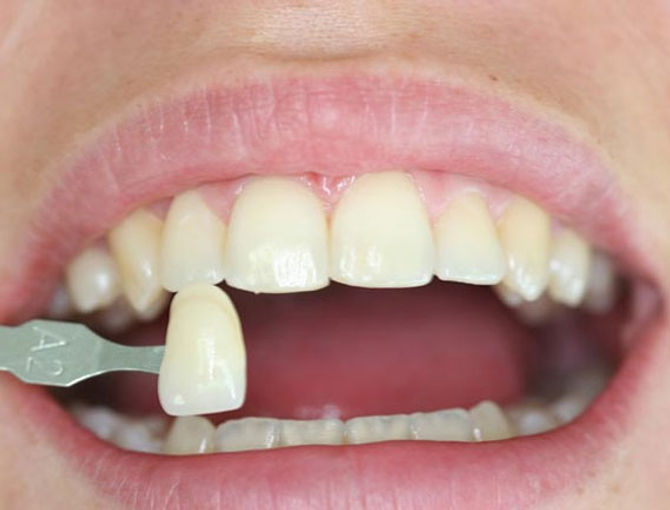 dental-veneers-arizona.jpg