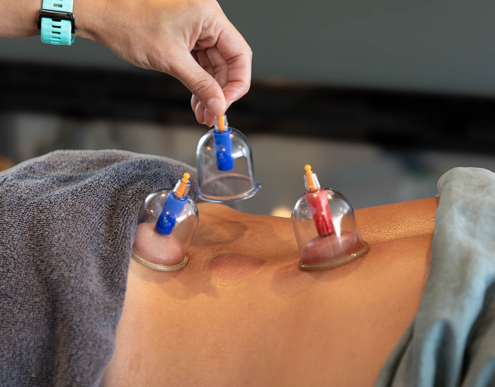 What Is Cupping?
