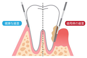 歯周病治療　こいけ歯科