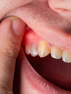 Le cisti orali: un problema comune ma poco conosciuto