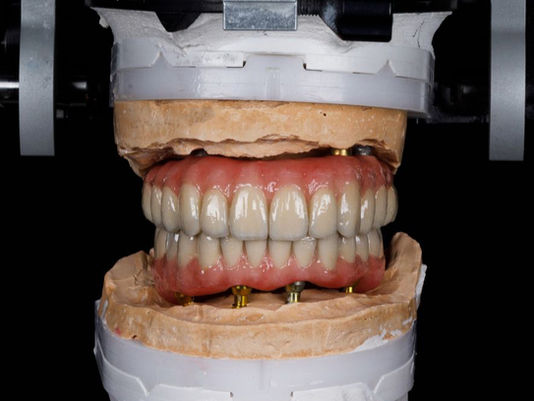 Modello implantologia All on 4 con quattro impianti dentali e protesi fissa