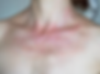 Sun damage Erythema.png
